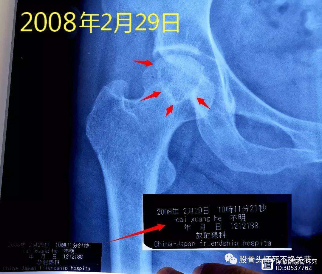 扬州人工骨头医保报销多少(人工骨头医保报销多少比例)